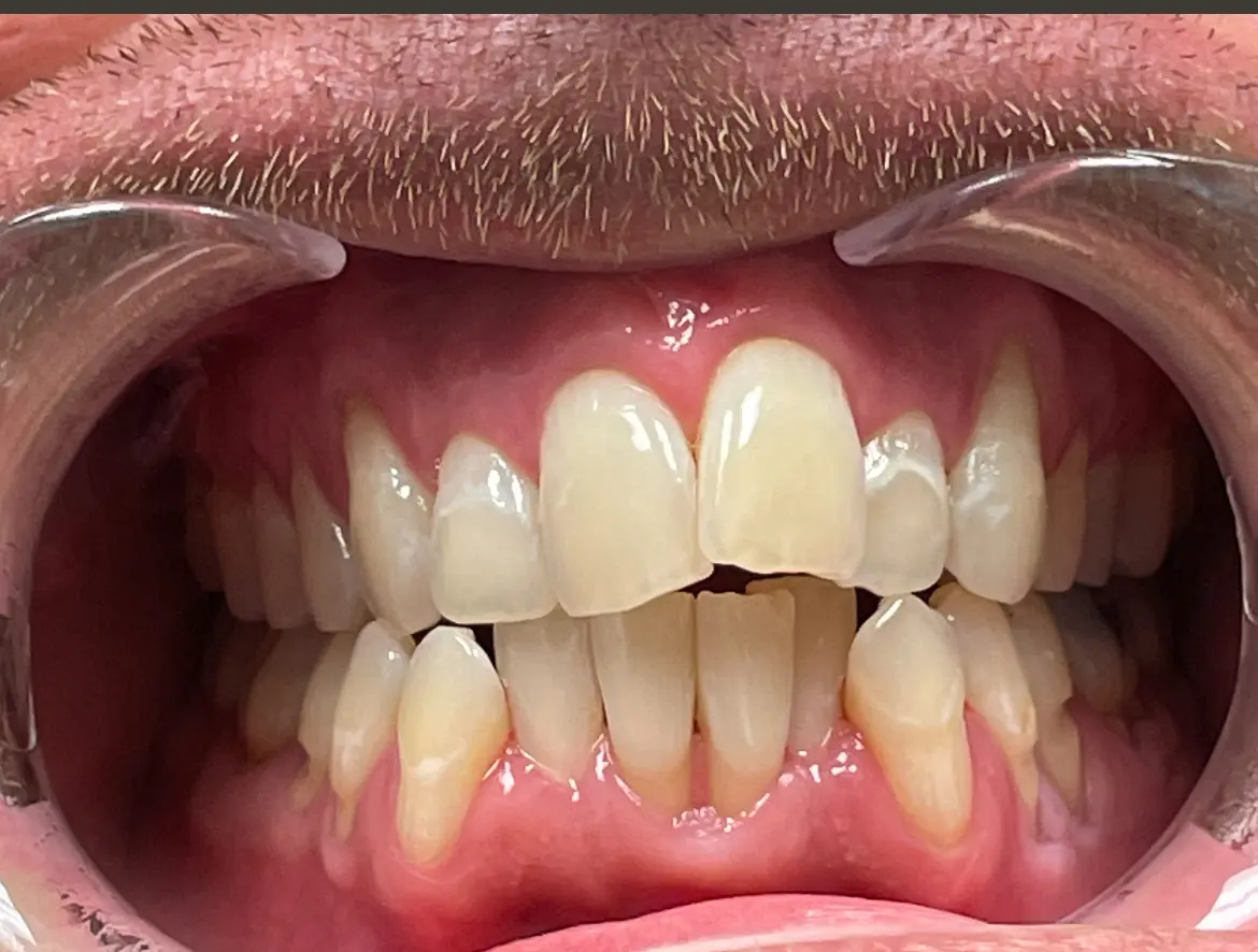 Restoration Dental