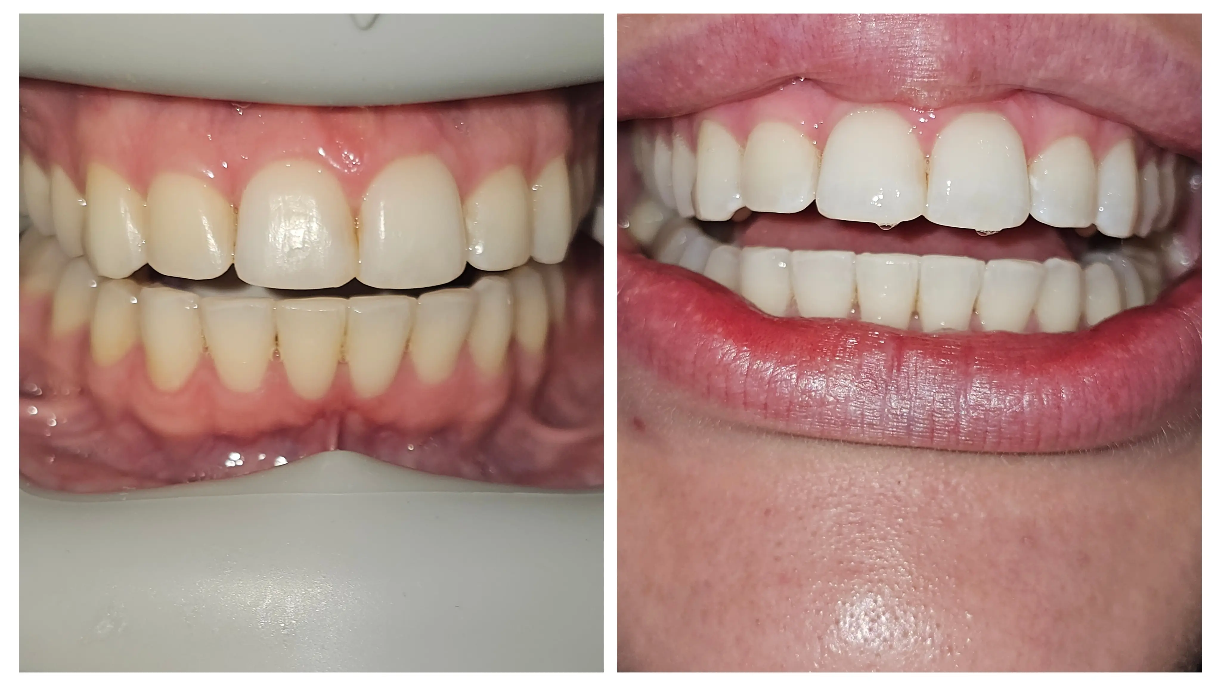 Miami Whites Teeth Whitening