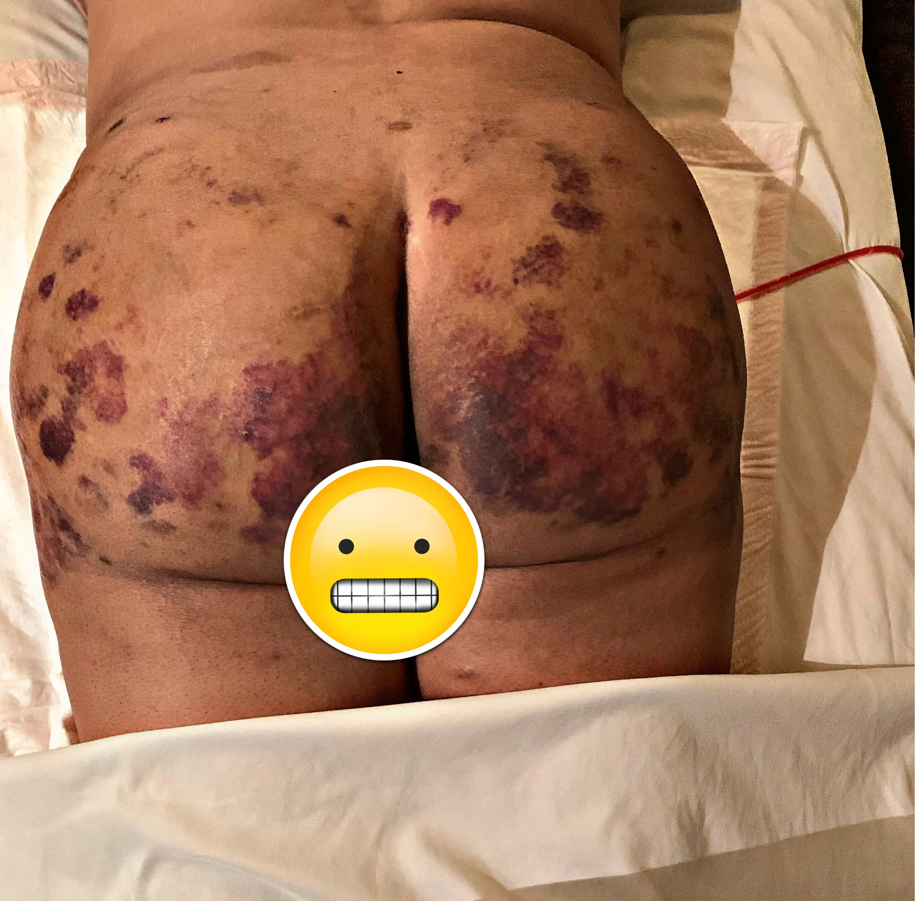 Chicago Manual Lymphatic Drainage Massage