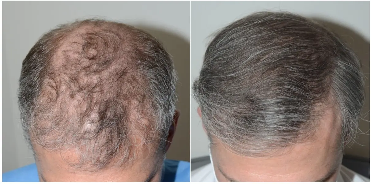 Foundation Aesthetic Hair Restoration