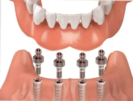 City Dental- Dental Implants and Orthodontics