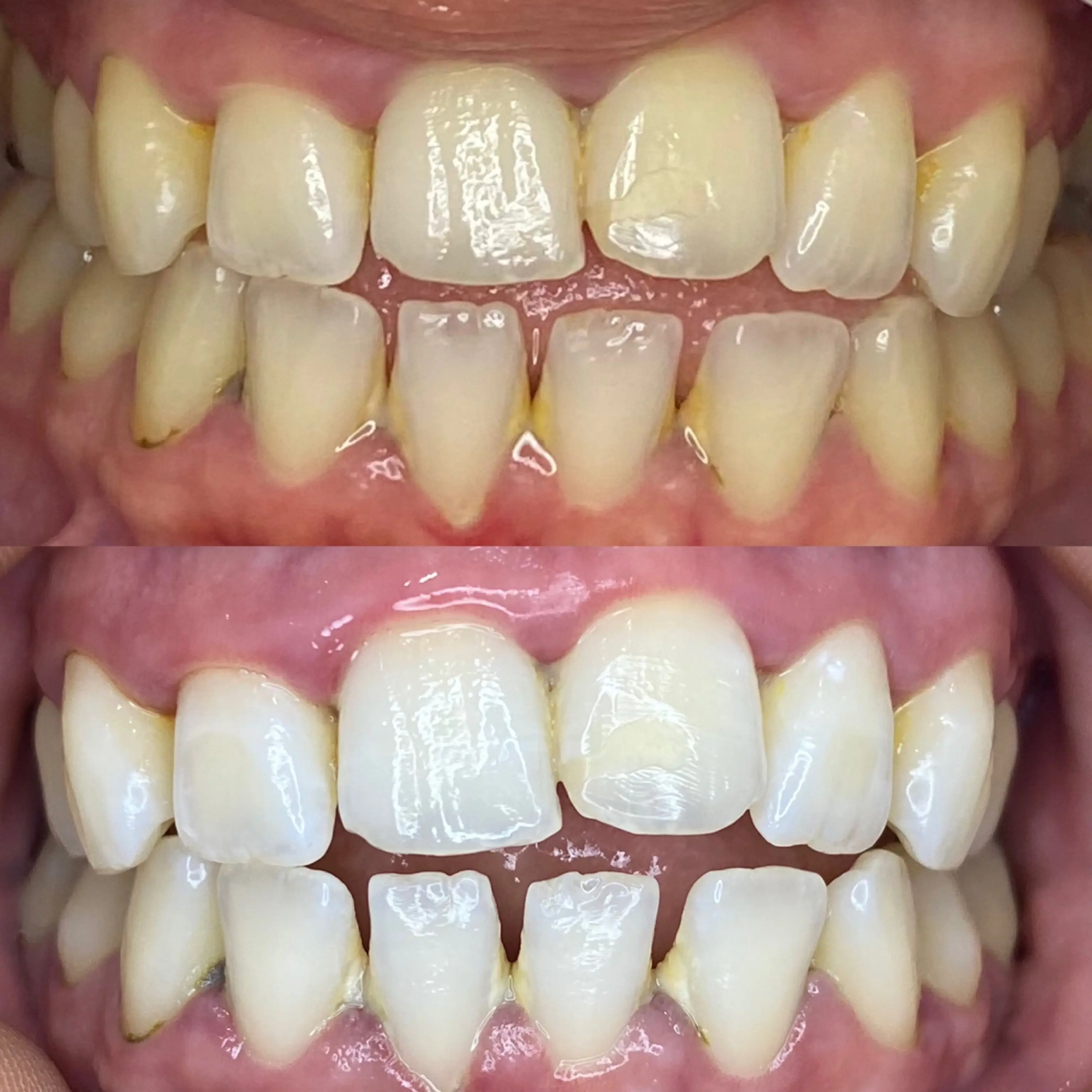 We Whiten Teeth Whitening