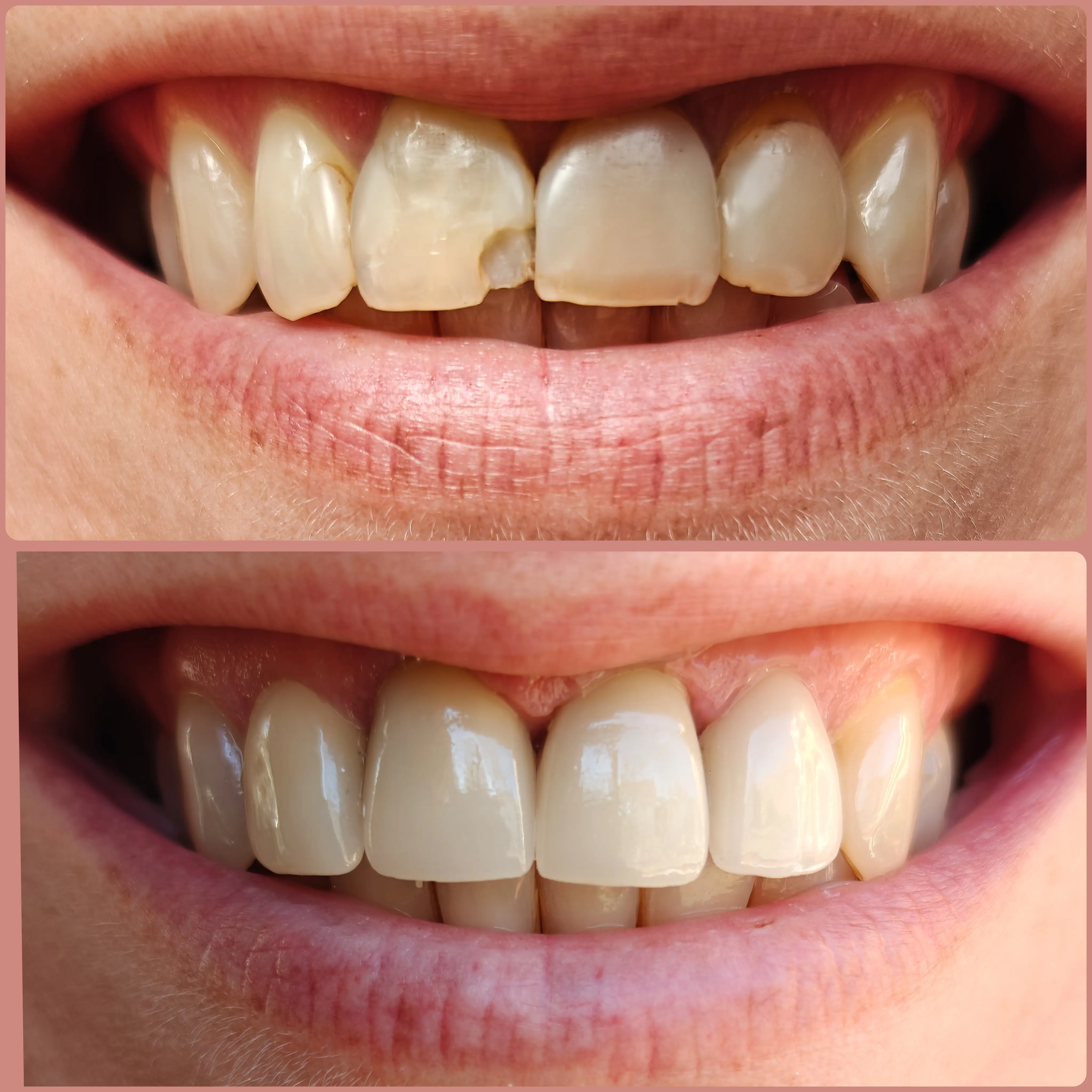 Tru Plano Dental