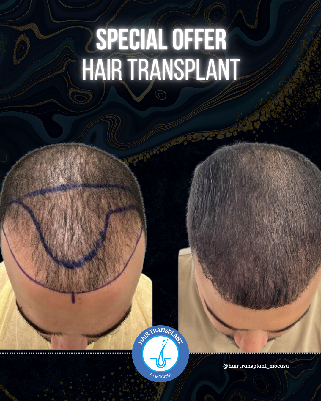 Hair Transplant by Mocasa